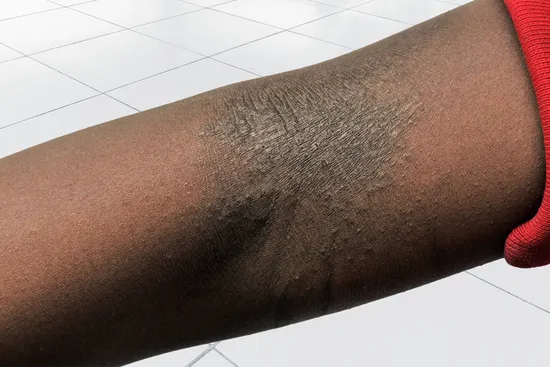 photo of eczema on boy's arm