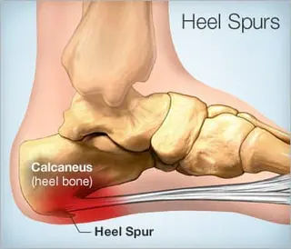 Picture of heel spur