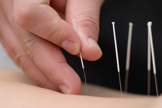 Physical Therapy, Acupuncture, and More