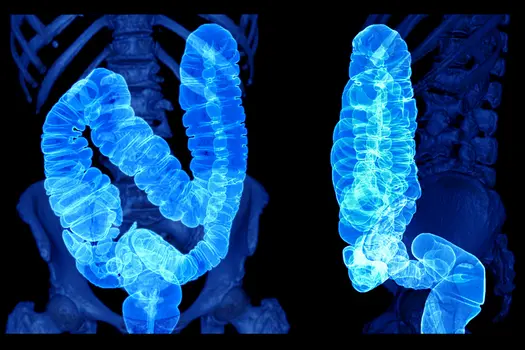 photo of ct scan of colon