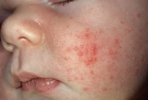 Picture of infant acne