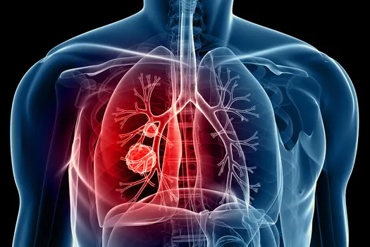 lung cancer medical illustration