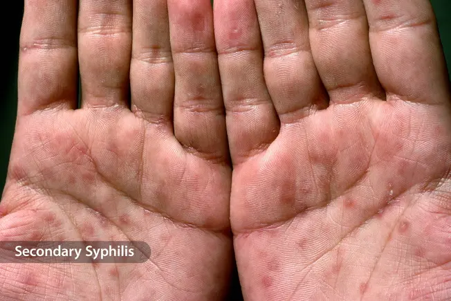 Syphilis Rash